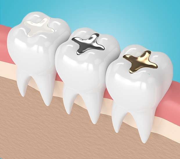 Port Chester Tooth Colored Fillings