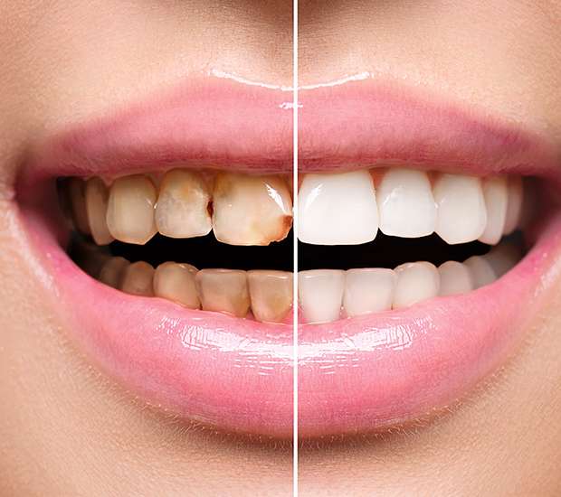 Port Chester Dental Implant Restoration
